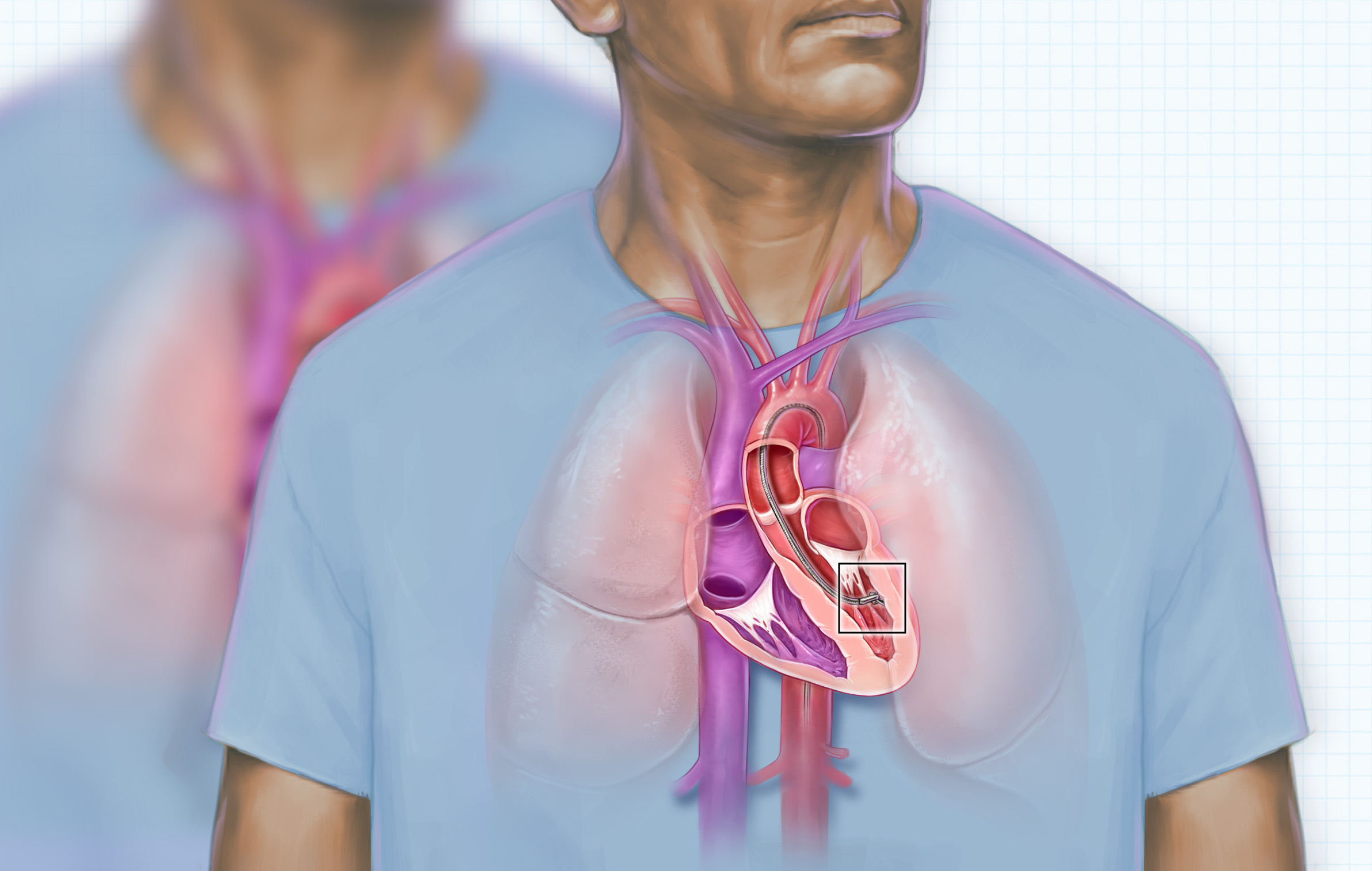 Medical-illustration-thumbnail