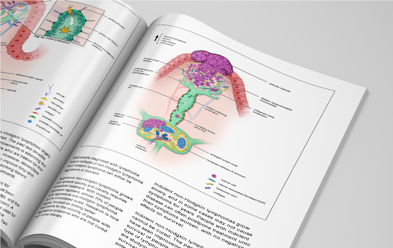 Biomechanics of the lymphatic system in cancer medical illustration