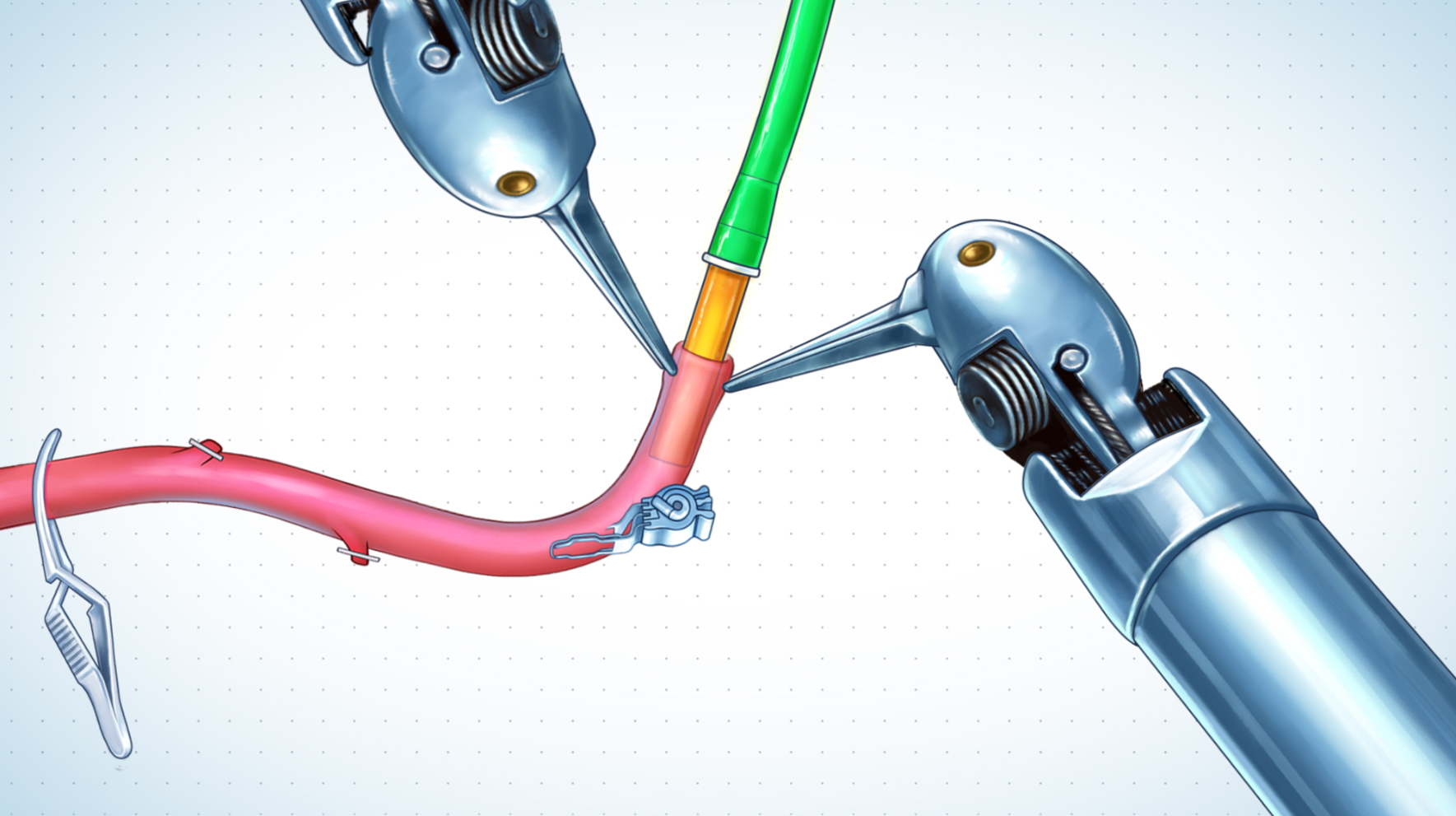 Surgical illustration of laser catheter insertion into graft – ELANA bypass procedure
