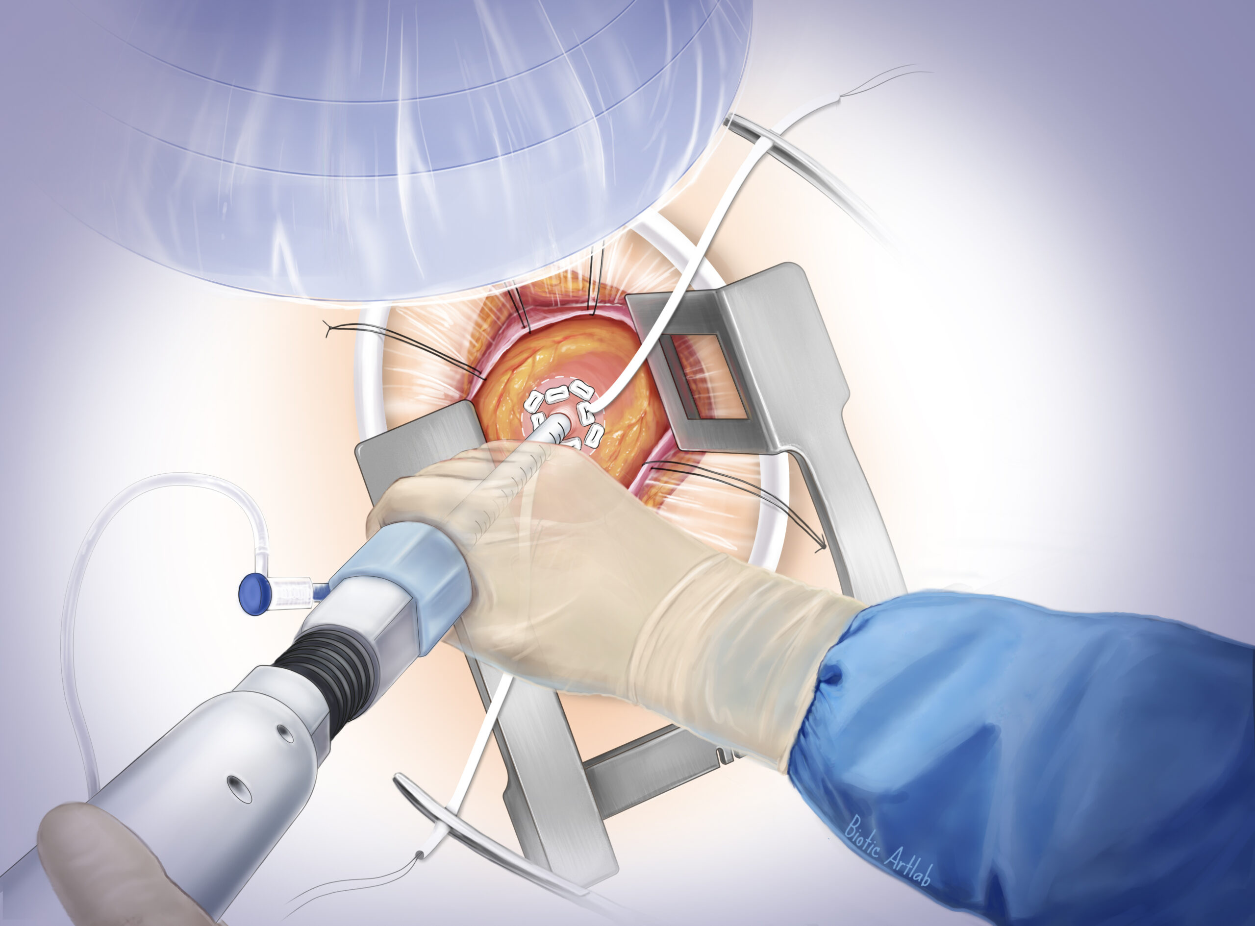 Sheath insertion step in Tendyne mitral valve replacement illustration