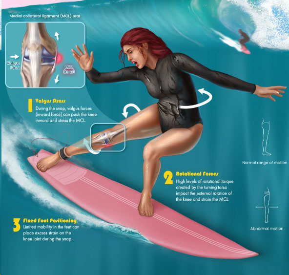 Surfer executing snap maneuver – biomechanical illustration of MCL tear risk