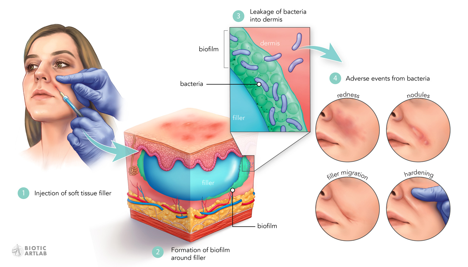 Graphical abstract medical illustration for Tom Decates scientific research publication