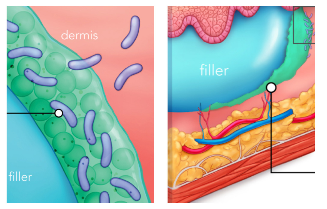 Biofilm formation around dermal facial filler – side effects medical illustration