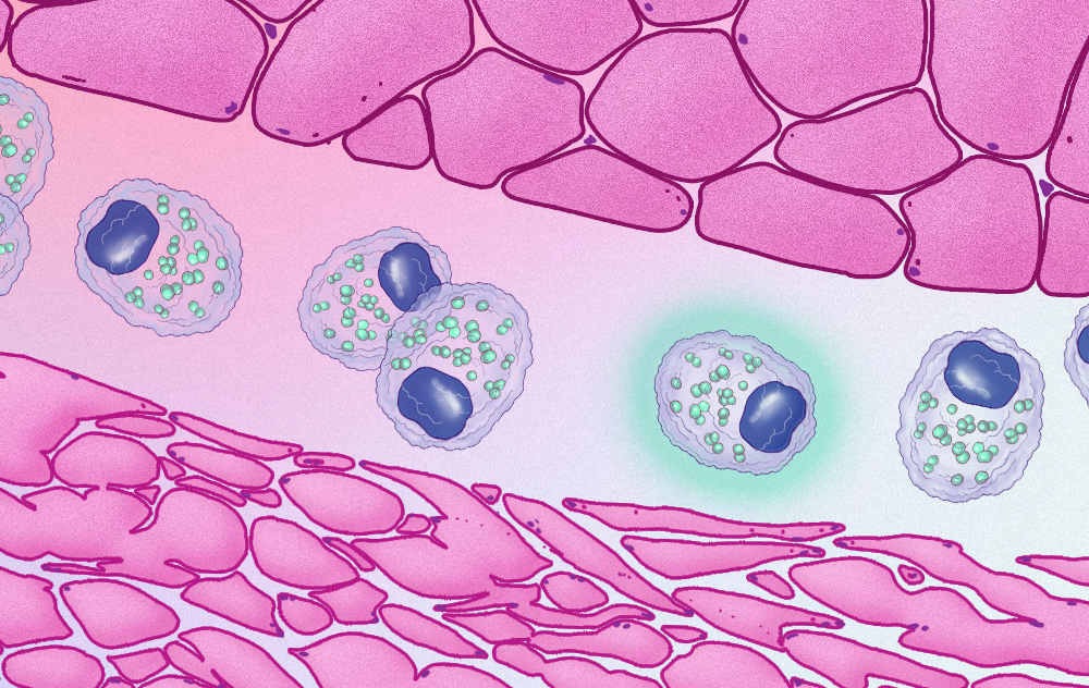 Cancer cachexia medical illustration showing metabolic muscle wasting