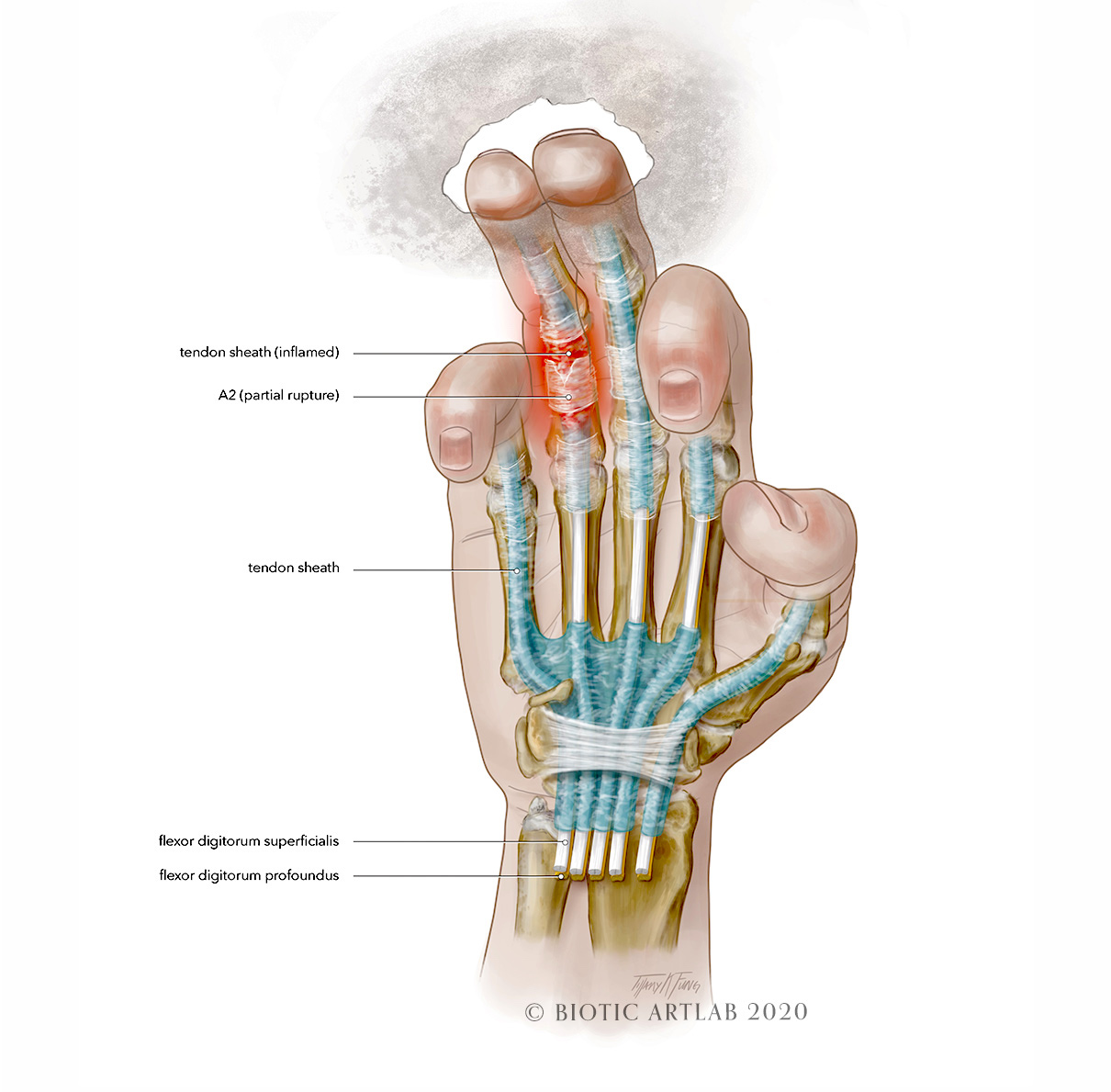 Rock climbing hand injury medical illustration – palmar view