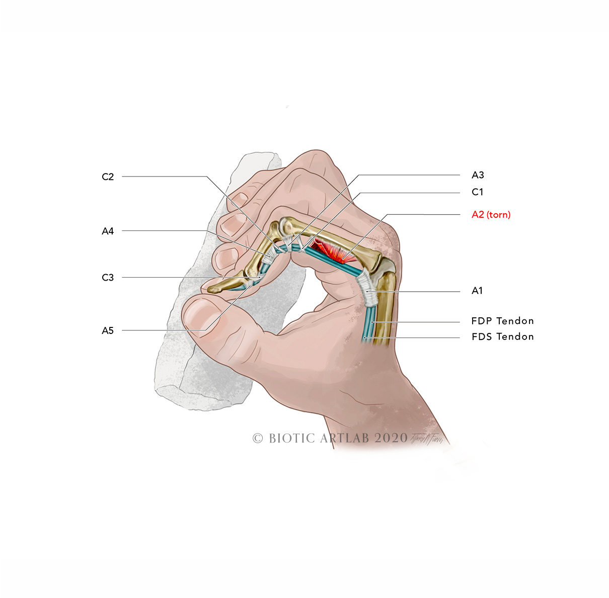 Rock climbing finger ligament injury medical illustration