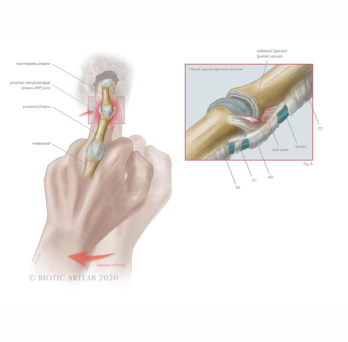 Rock climbing hand injury anatomy illustration – lateral view
