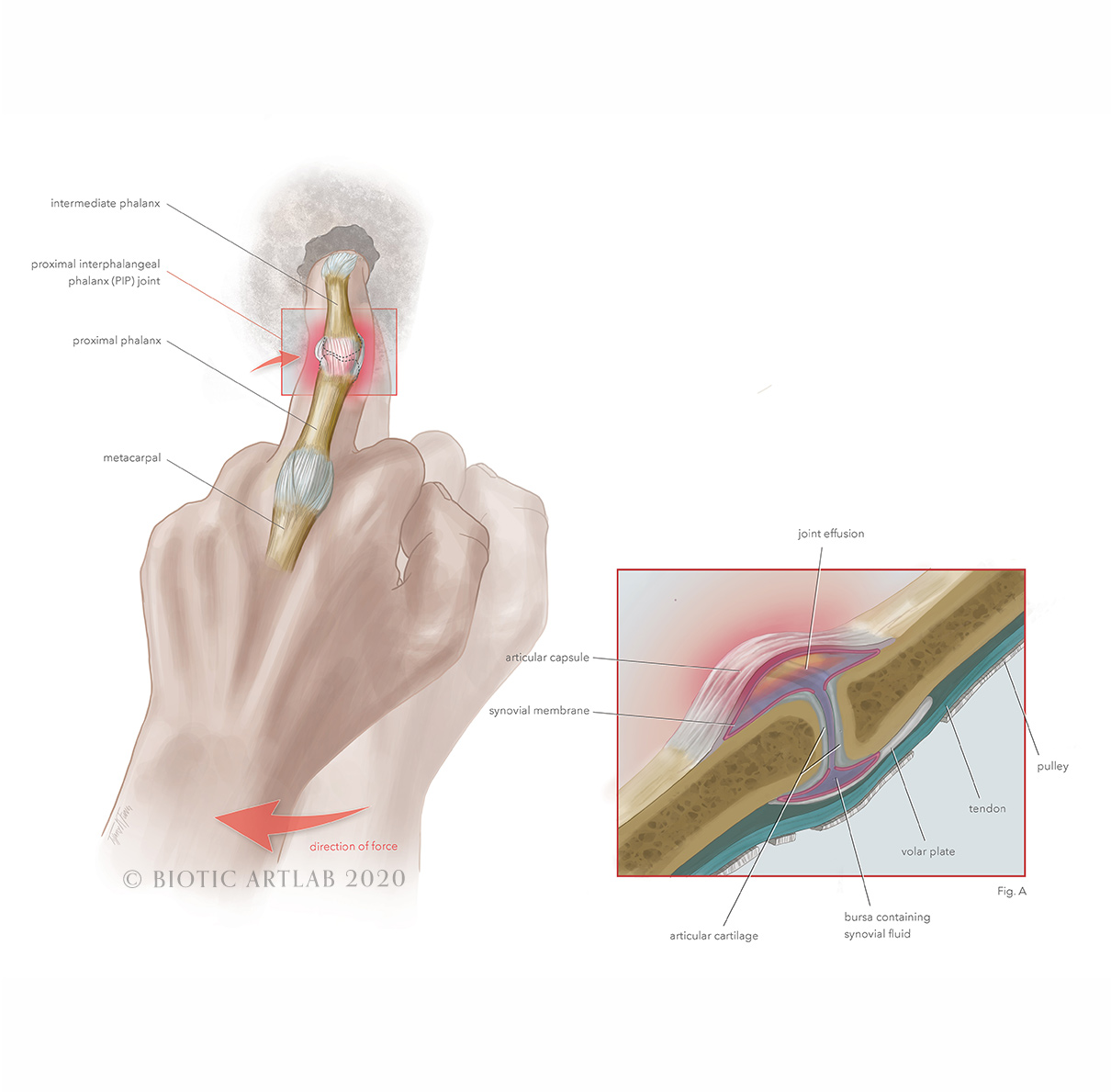 Rock climbing hand injury medical illustration – dorsal view