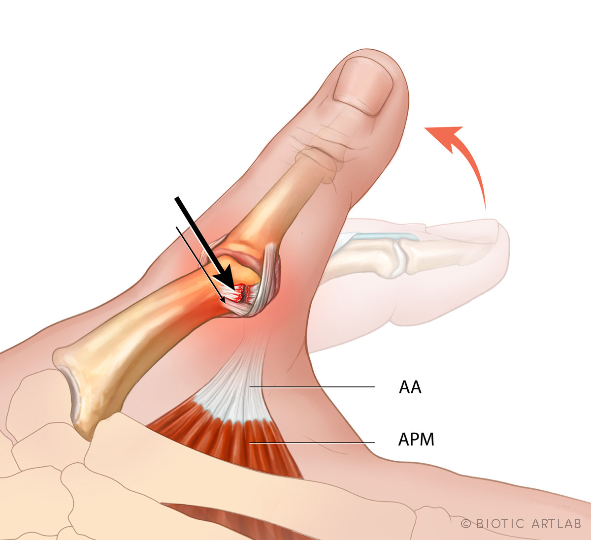 Stener lesion injury medical illustration for rock climbing finger pathology
